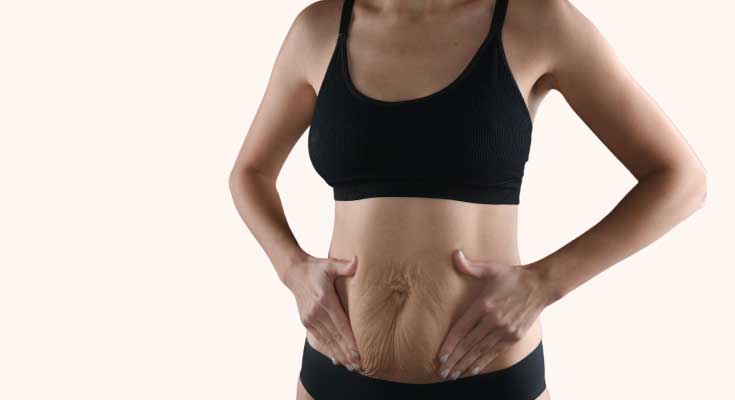 Mit VelaShape III und dem Fraxis Laser können Sie Ihr Wohlbefinden und Selbstvertrauen nach der Schwangerschaft steigern bei Dr. Charlotte Grillitsch - Med and Skin 